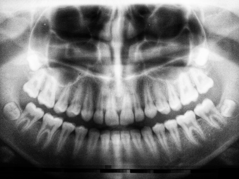 A dental radiograph used for implant planning